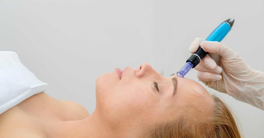 Top 5 Benefits of Microneedling